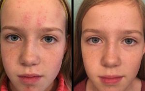 Young Girl using Miracle Products